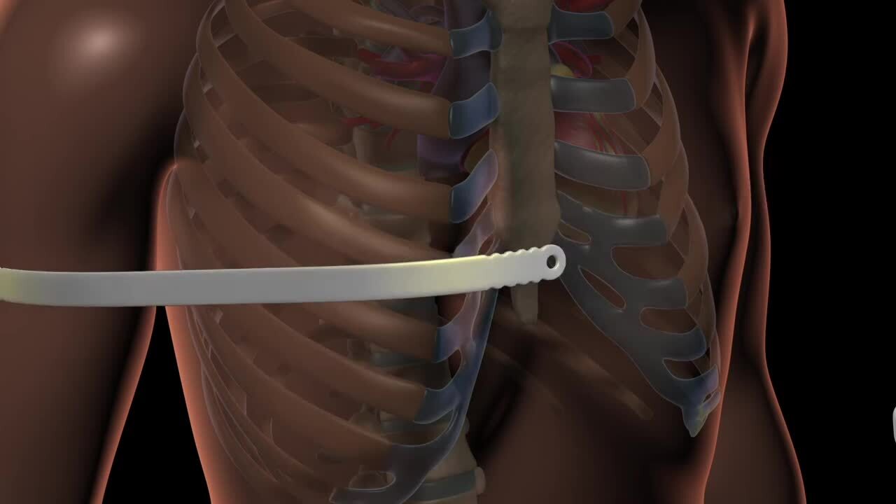 Pectus Excavatum Surgery at Children's Mercy